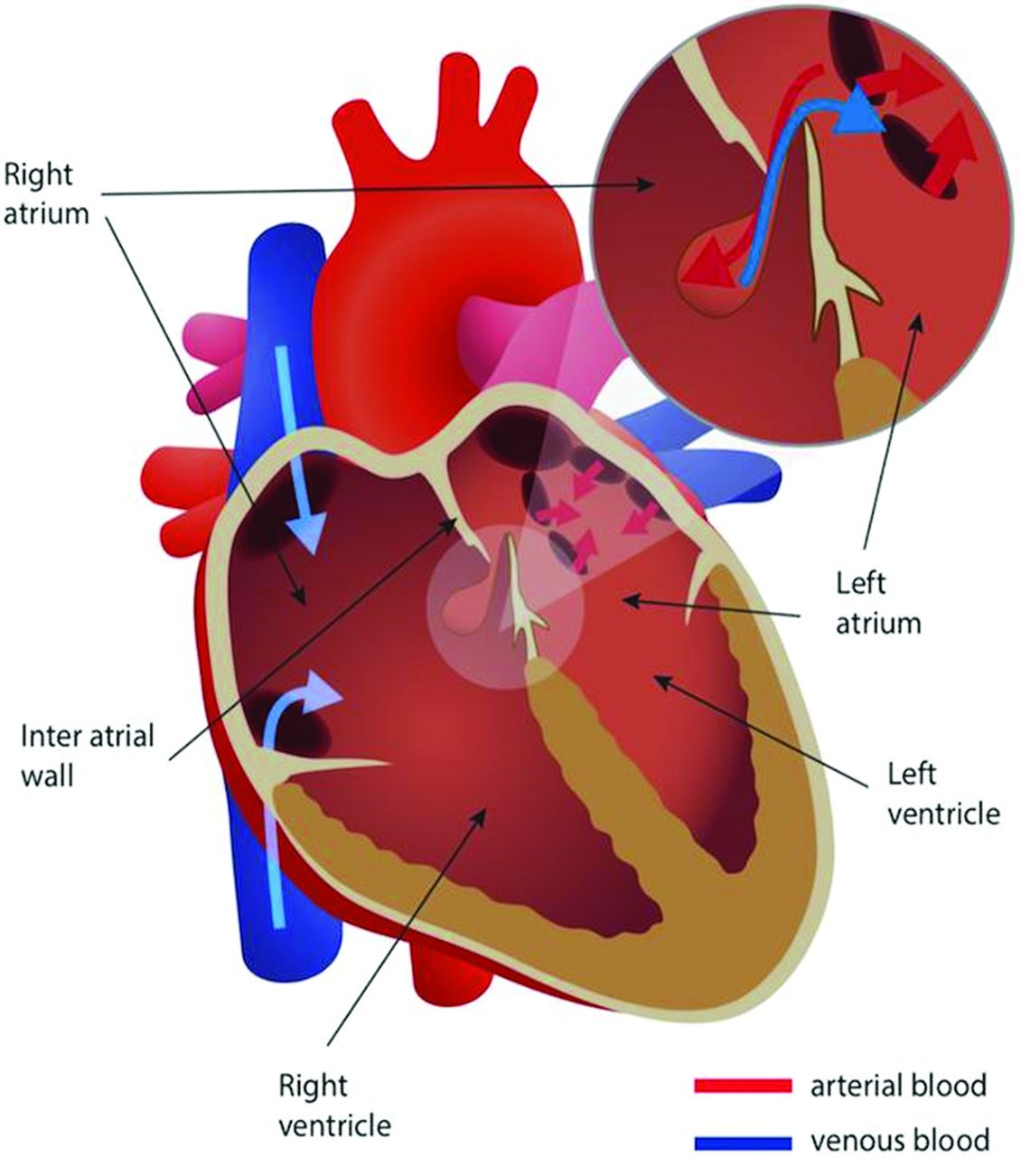 Patent Foramen Ovale(PFO): Treatment, Symptoms, Causes By Nidhi Gurjar ...