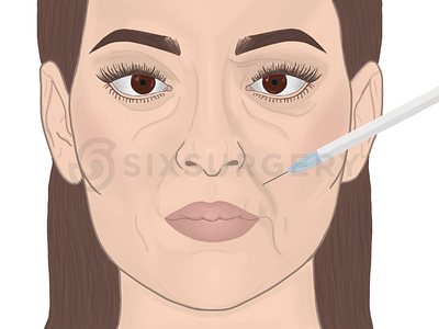 Facelift Medical Illustration