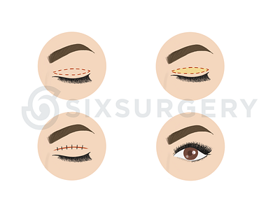 Eyelid Surgery Medical Illustration Demonstration