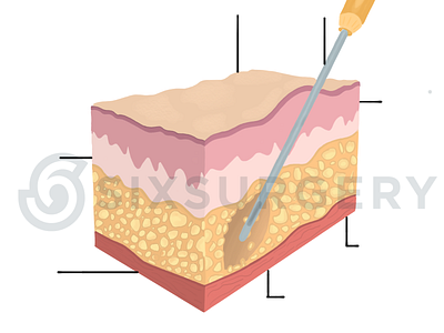 Liposuction Fat Medical Illustration