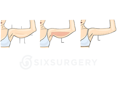 Arm Lift Medical Illustration