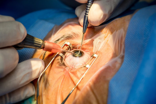 what-are-the-most-common-eye-surgeries-by-mark-cena-on-dribbble