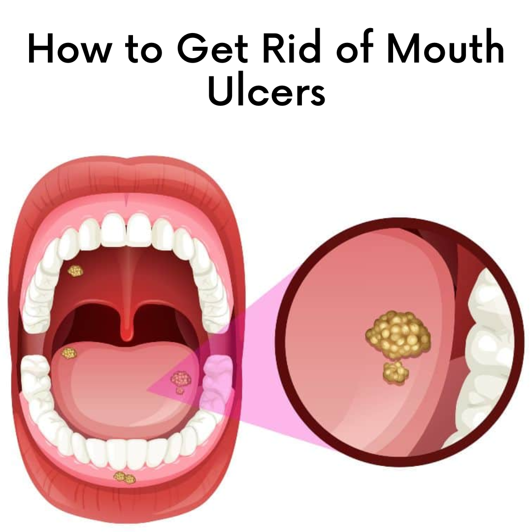 how-to-get-rid-of-mouth-ulcers-by-abir-on-dribbble