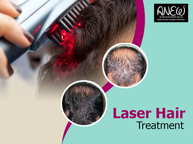 Laser hair removal in Bangalore Anew by Anew AESTHETIC DAY CARE on