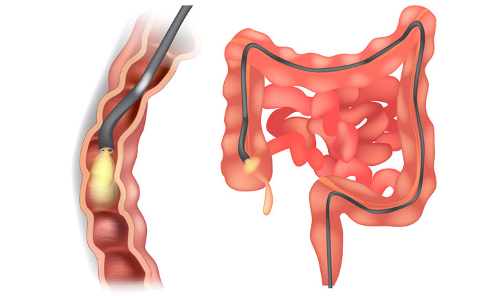 upper-gi-endoscopy