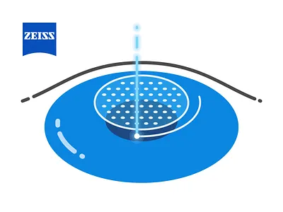 Eye surgery web json animation for Zeiss animation explanatory eye infographic infographics json laser line lottie medical medicine page pupil site surgery svg vector video web zeiss