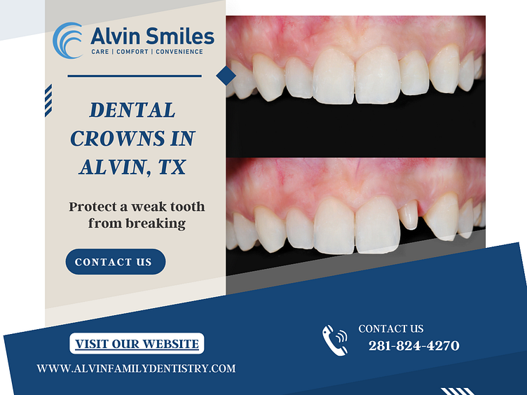 Dental Crowns In Alvin, TX Alvin Smiles by Alvin Smiles on Dribbble