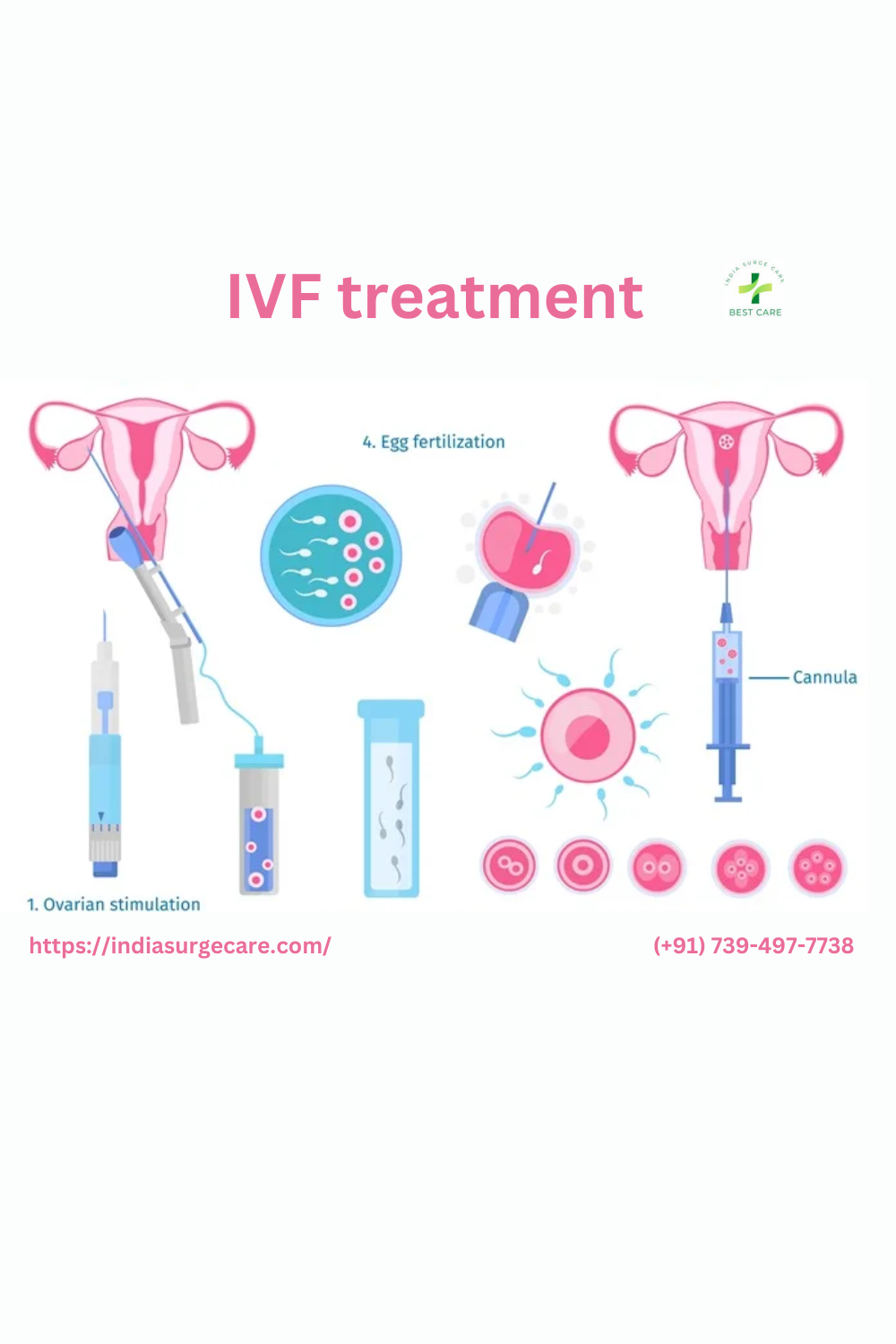 IVF Surgery in India by india surge care on Dribbble