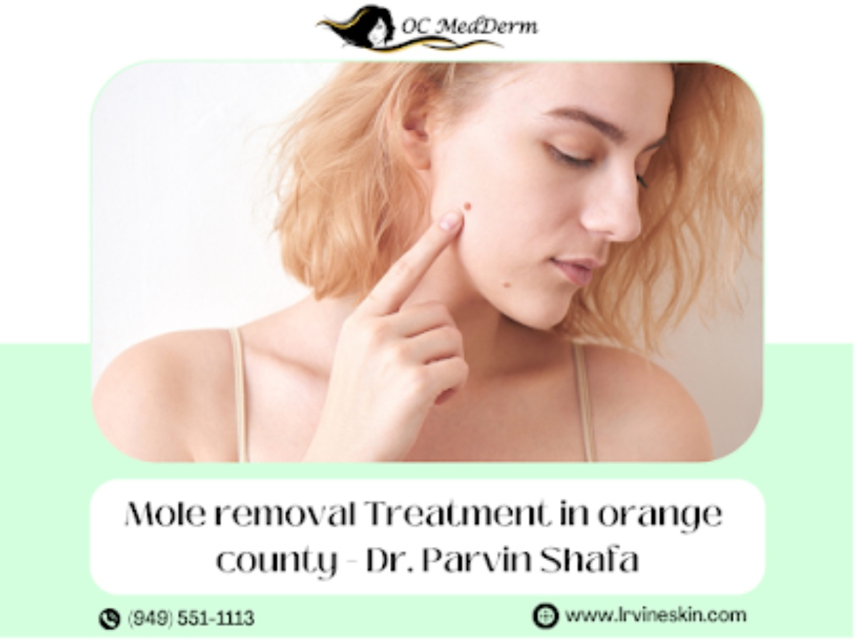 Best Mole Removal Treatment Irvine Ca Dr Parvin Shafa By Oc Medderm