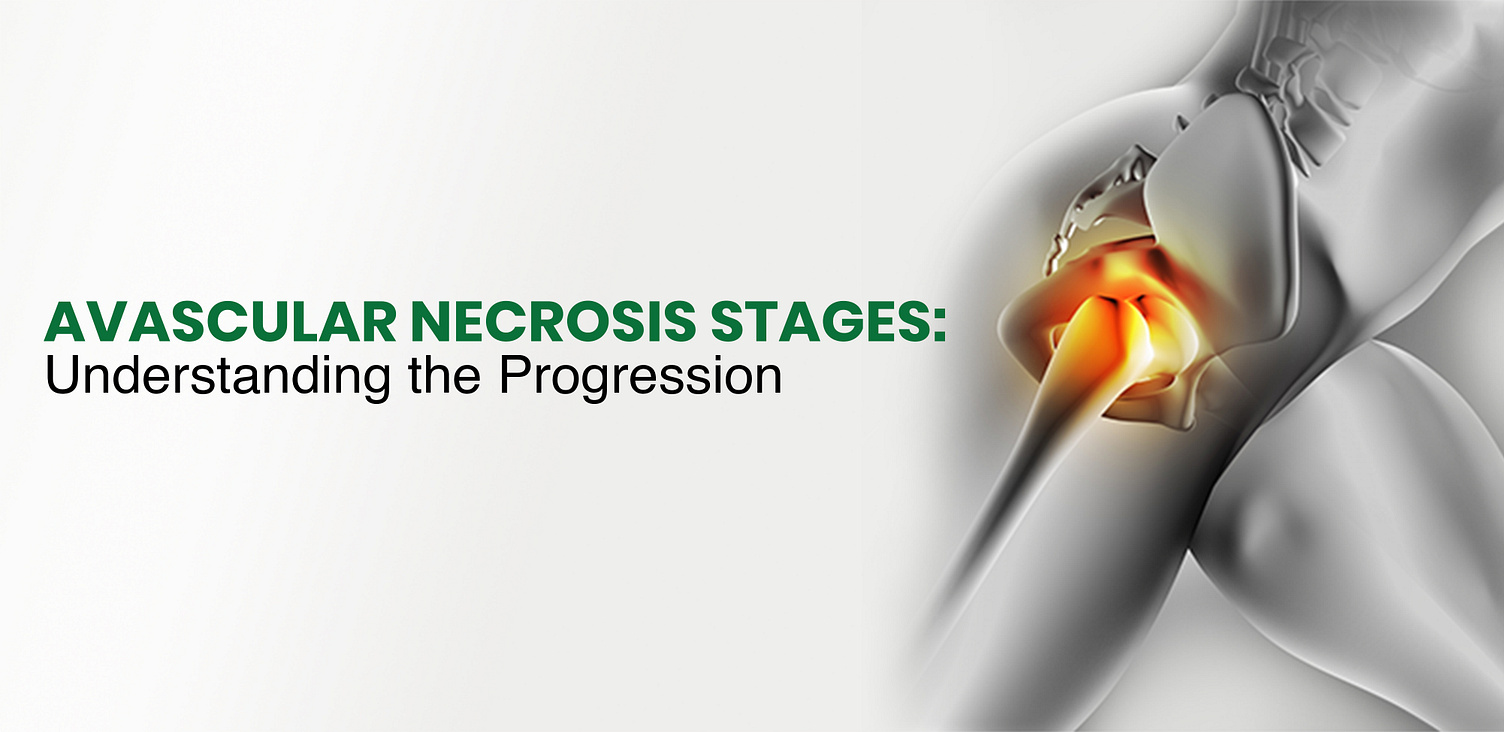 Avascular Necrosis Stages Understanding the Progression by regrow bioscience on Dribbble