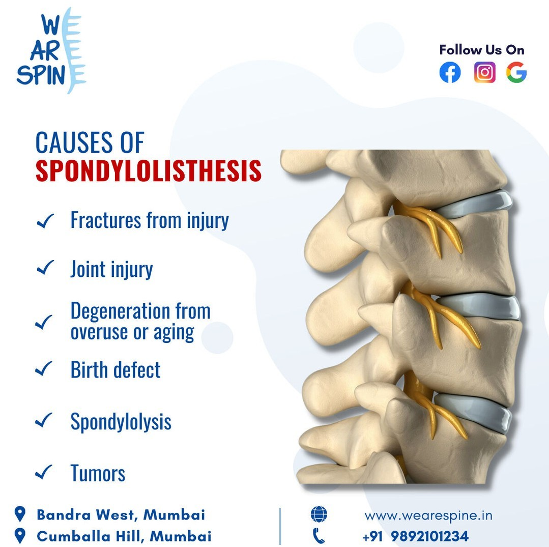 Causes of Spondylolisthesis by We are spine on Dribbble