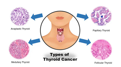 Thyroid Cancer: Types and Treatment Options blog branding graphic design logo ui