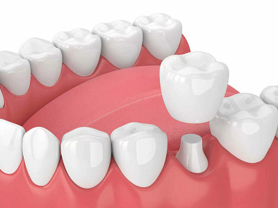 Improving Your Smile with Dental Crowns dental clinic in mississauga dental crown cost mississauga