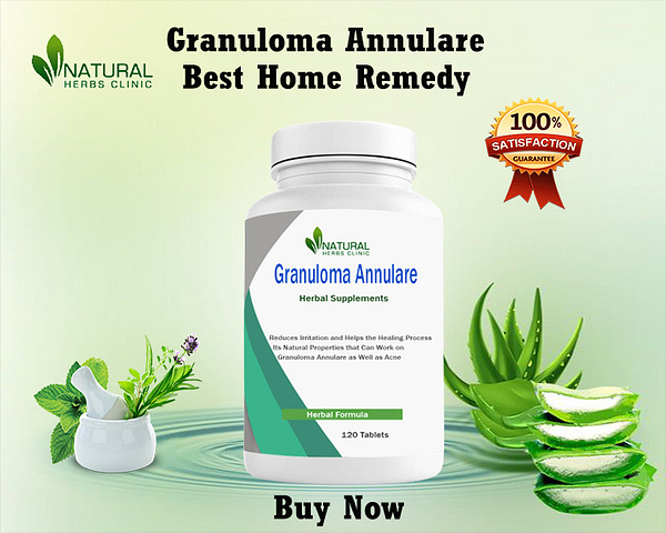 Natural Remedies for Granuloma Annulare