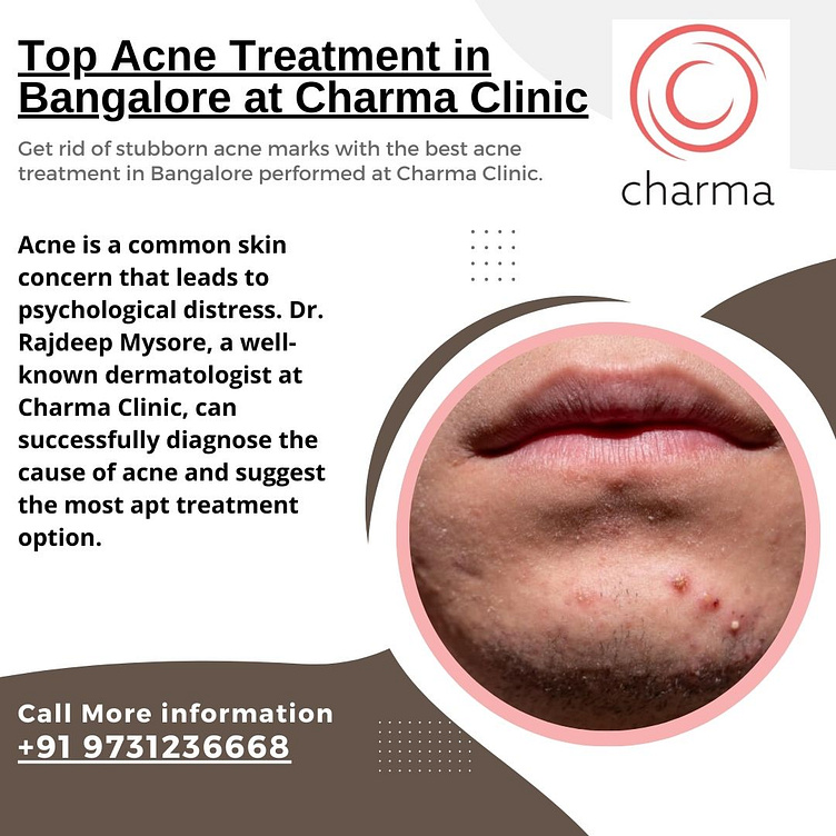 top-acne-treatment-in-bangalore-at-charma-clinic-by-charma-clinic-on