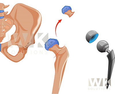 Total Hip Replacement 3d graphic design illustration medical illustration totalhipreplacement