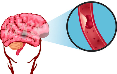 Carotid brain carotid graphic design illustration medical illustration