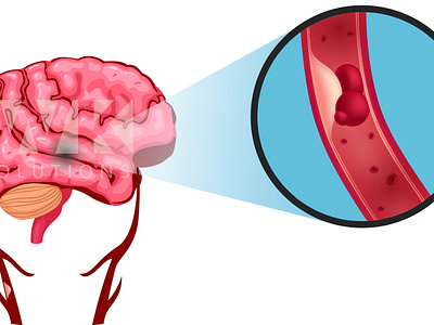 Carotid brain carotid graphic design illustration medical illustration