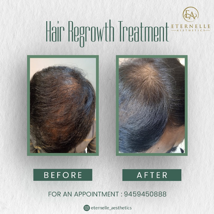 Before&After Hair Regrowth Treatment Hair Growth Boosters by Eternelle