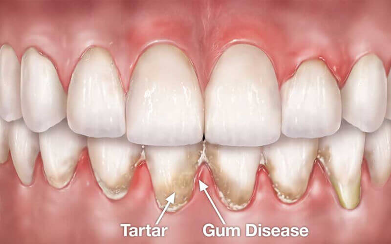Everything You Should Know About Gum Pockets & Treatment Option by Dr