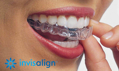 Nieng rang invisalign la gi?