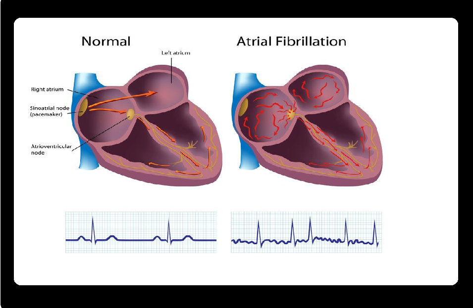 Atrial fibrillation Overview, Symptoms, Causes & Treatment by Nauka ...