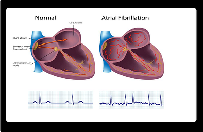 Atrial Fibrillation Overview, Symptoms, Causes & Treatment By Nauka 