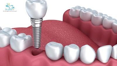 Dịch vụ cấy ghép Implant toàn hàm – Nha khoa Dr Smile