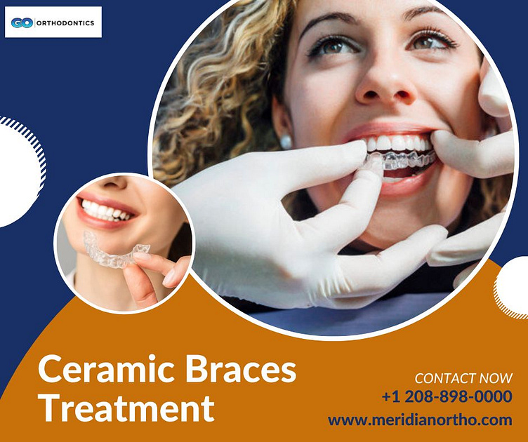 Ceramic Braces Treatment by Guymon Orthodontics on Dribbble