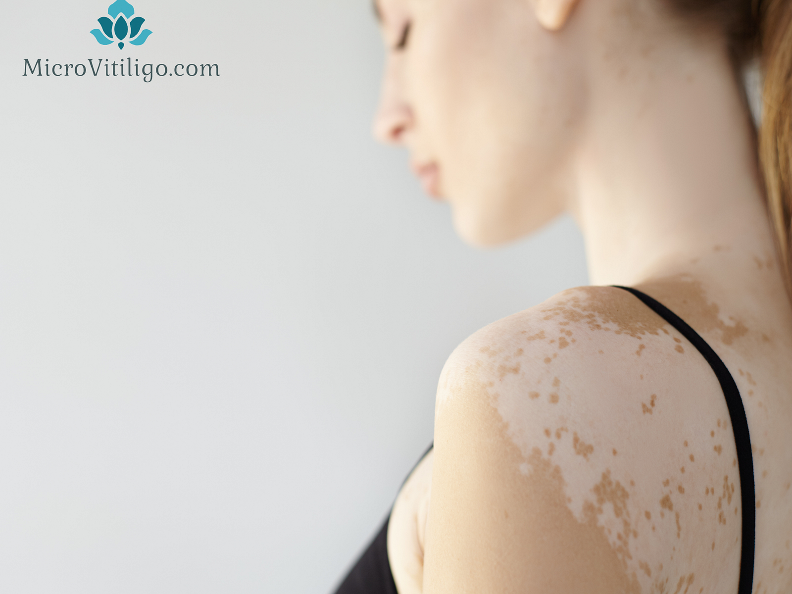 Discover Micropigmentation for Vitiligo Near You! by Micro Vitiligo ...