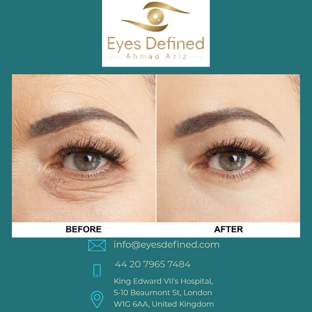 how-long-does-the-results-of-blepharoplasty-last-by-eyes-defined-on