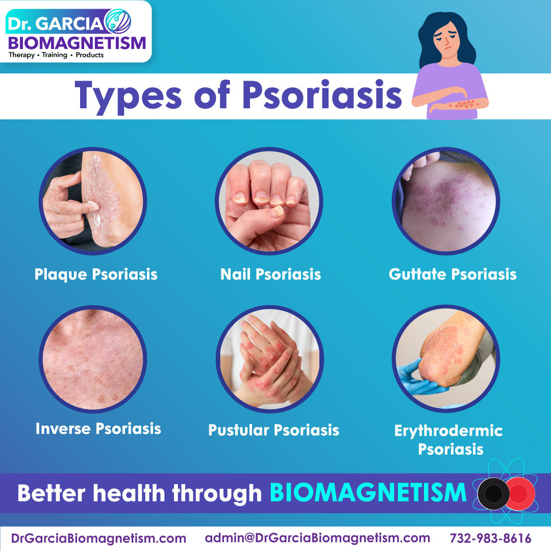 Exploring Psoriasis Types and Biomagnetism Therapy by drgarcia ...