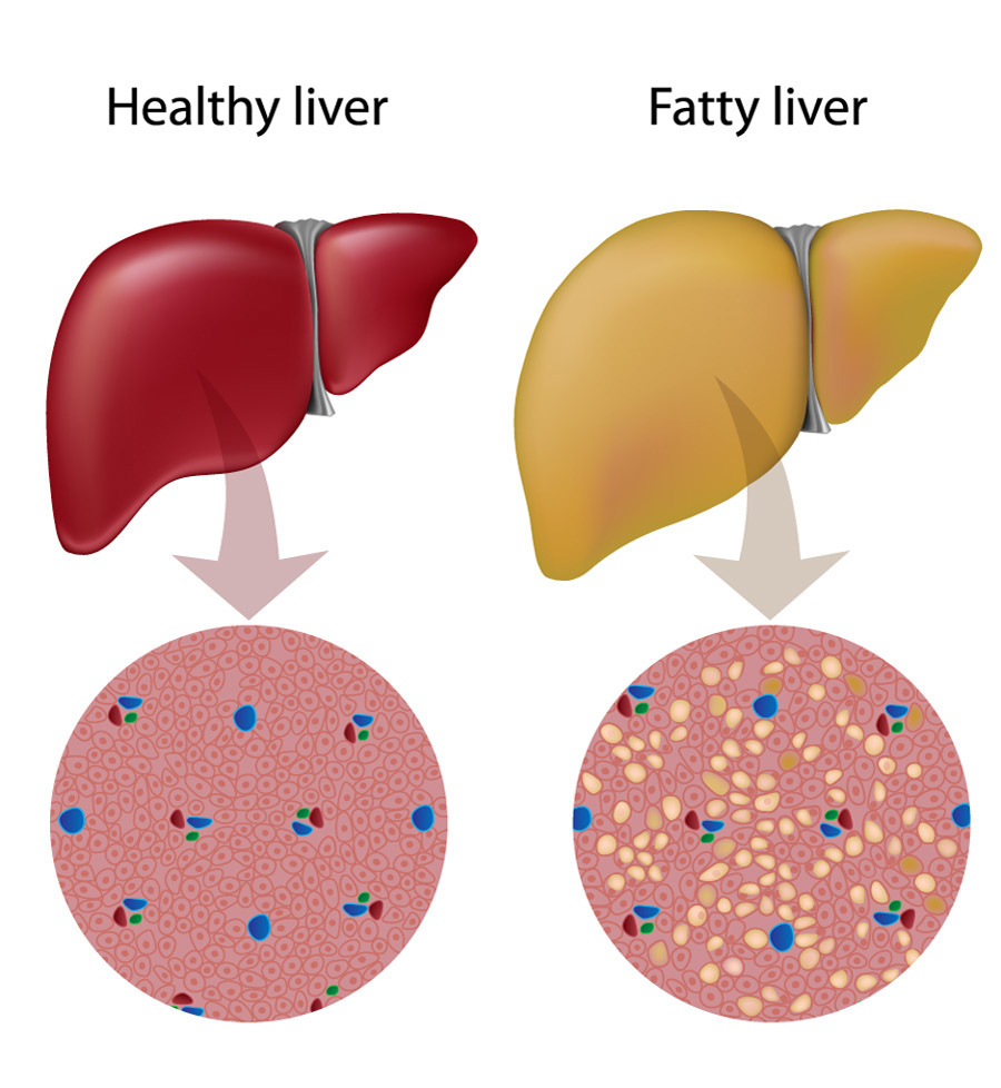 what-are-the-symptoms-of-fatty-liver-disease-by-globus-hospital-on