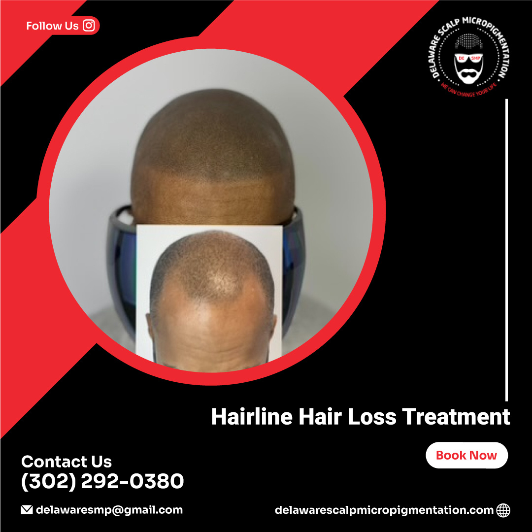 Hairline Hair Loss Treatment Delaware SMP by Delaware Scalp