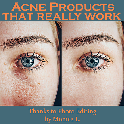 Acne Products: Photo Editing Ad graphic design