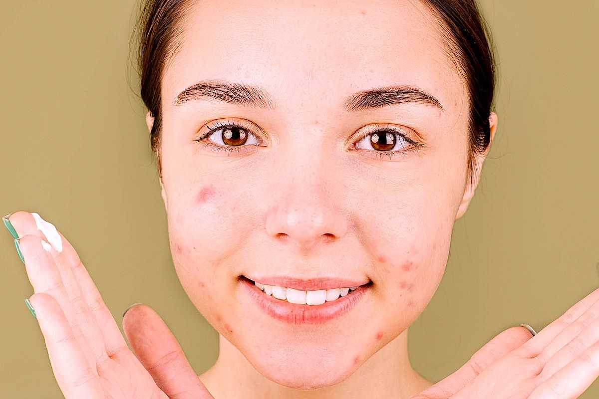How to Get Rid of Acne Scars Quickly Exploring Vitastem Ultra by